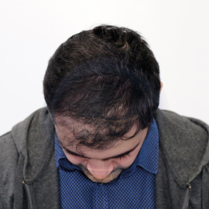 treatment for hair loss