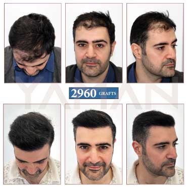 2960 Grafts - 10 Months Result