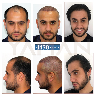 4450 Grafts Before - After