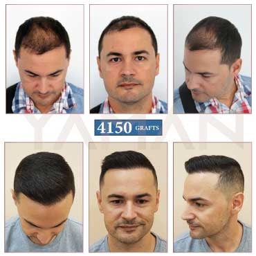 4150 Grafts Result