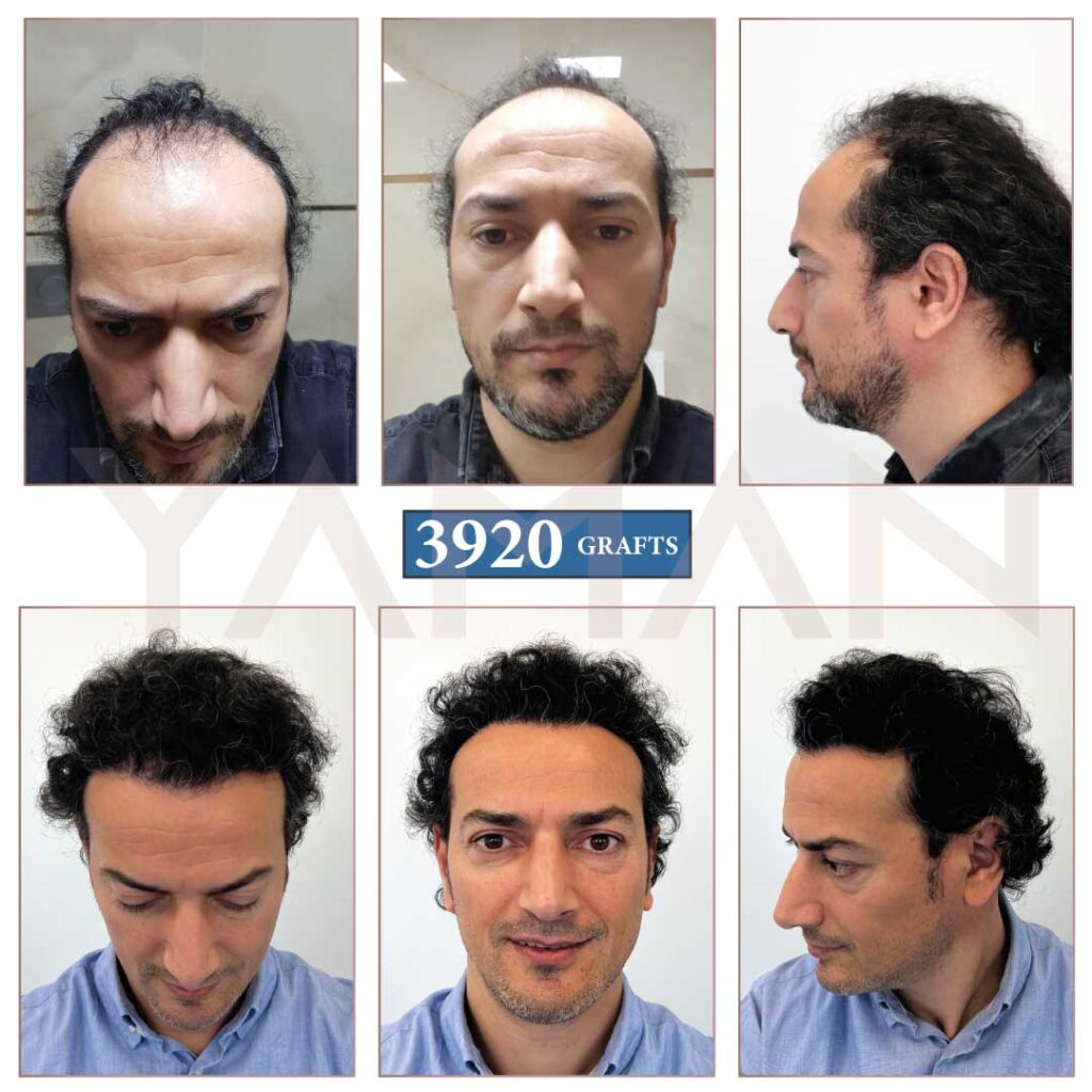 3920 Grafts hair transplant