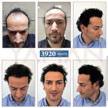 3920 Grafts – 9 Months Result