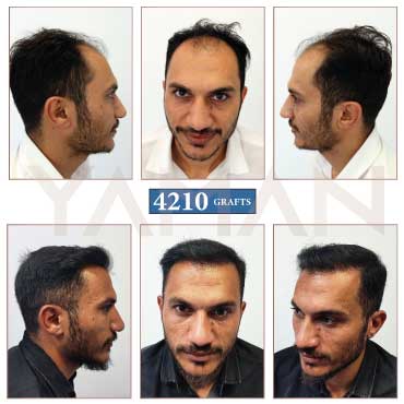 4210 Grafts - 16 Months Result