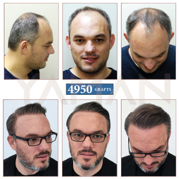 4950 Grafts - 7 Years Result