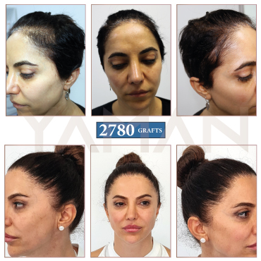 2780 Grafts Before - After