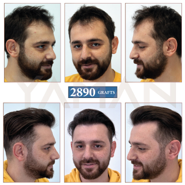 2890 Grafts - 2 Years Result