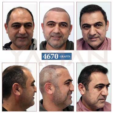 4670 Grafts Before - After