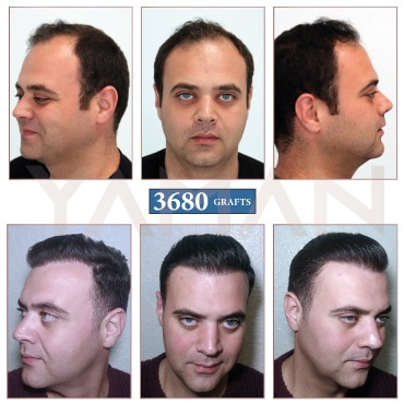 3680 Grafts Before - After