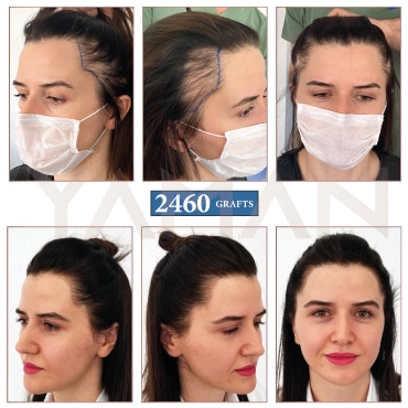 2460 Grafts Before - After