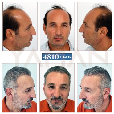 4810 Grafts - 5 Years Result