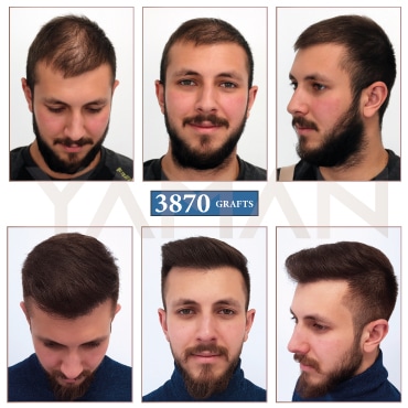 3870 Grafts Result