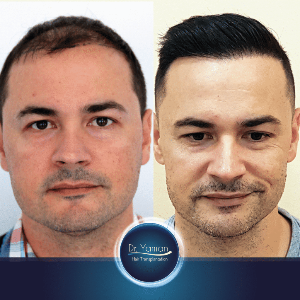Hair Transplant Cost Turkey