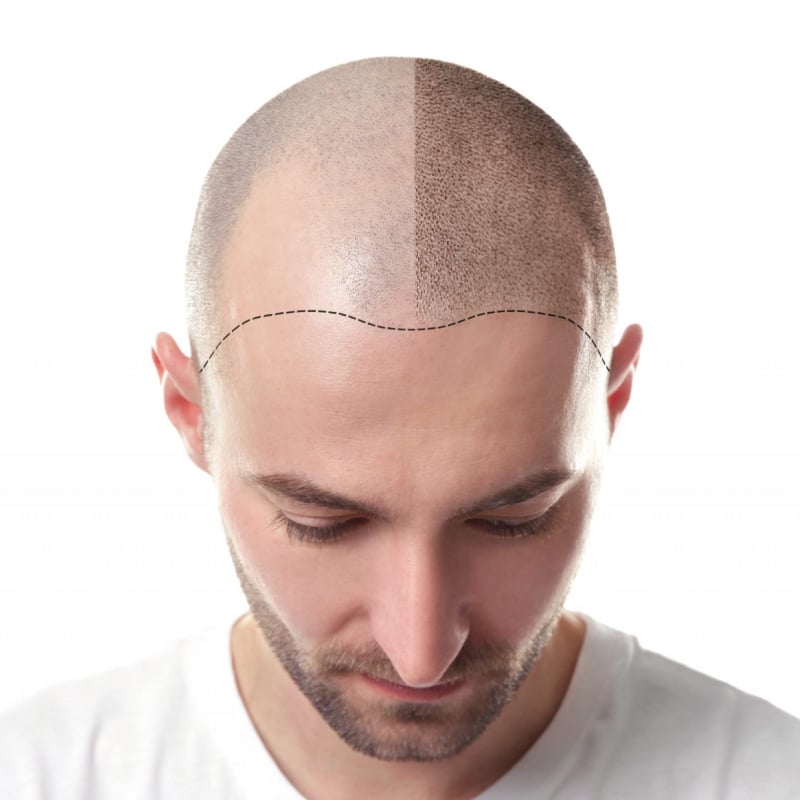 Scalp Micropigmentation