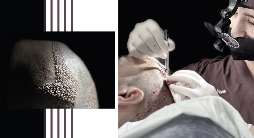 turkey hair transplant cost