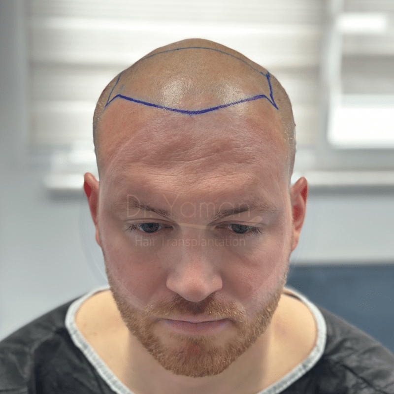 fue hair transplant turkey