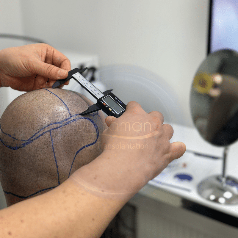 DHI Hair Transplant in the Crown Region- Vertex Area