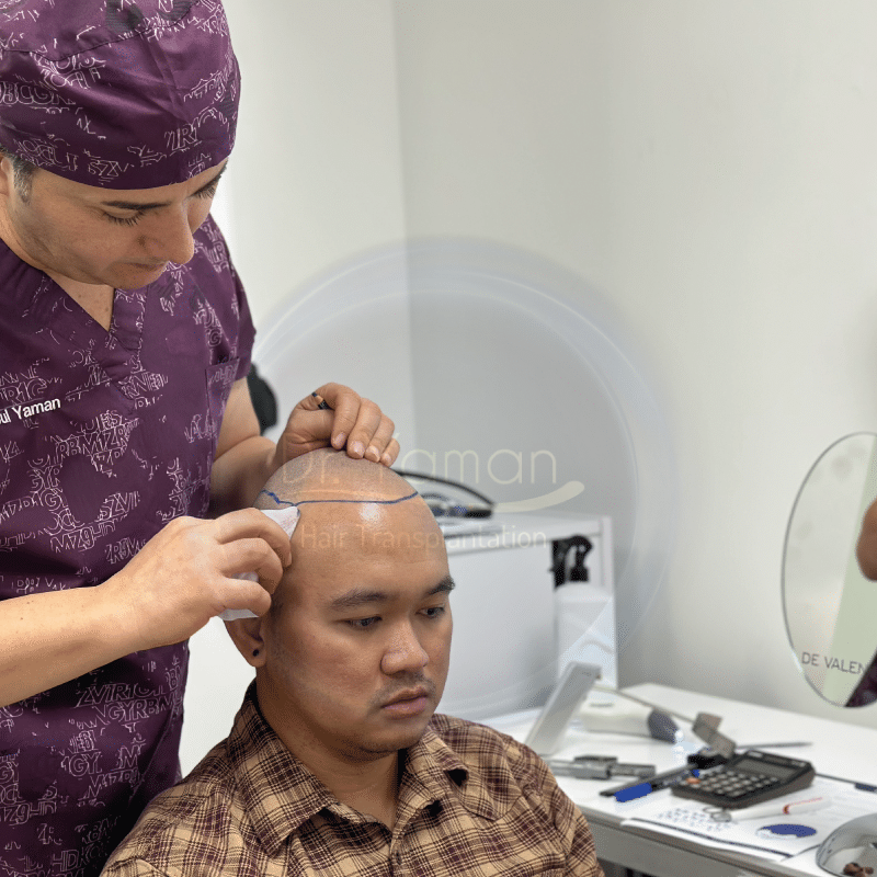 fue hair transplant turkey