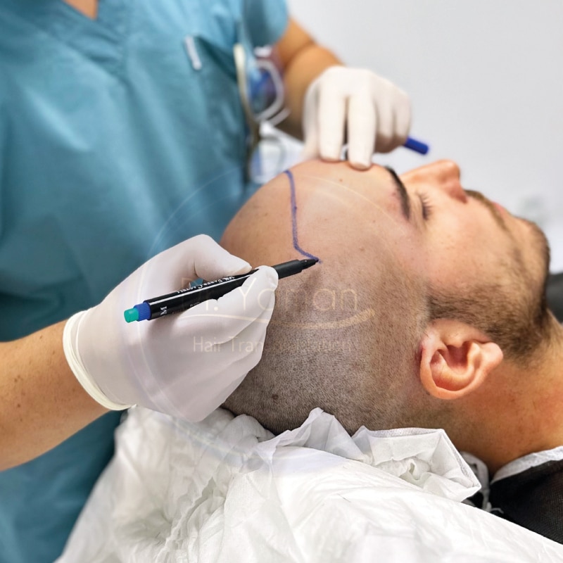 FUE Hair Transplant