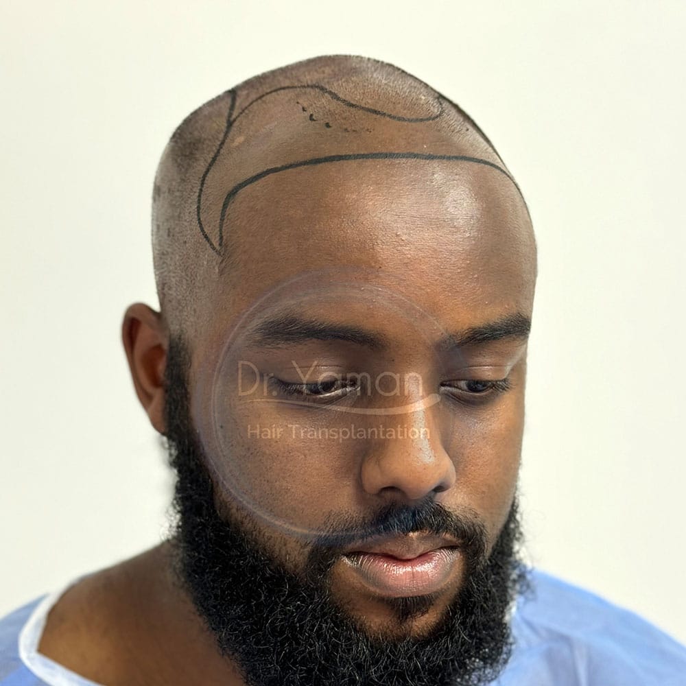 Does DHI Work on Afro?