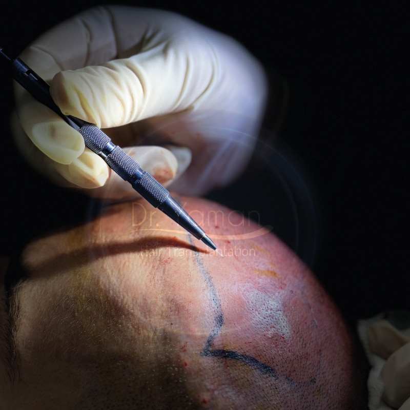 Sapphire Hair Transplant