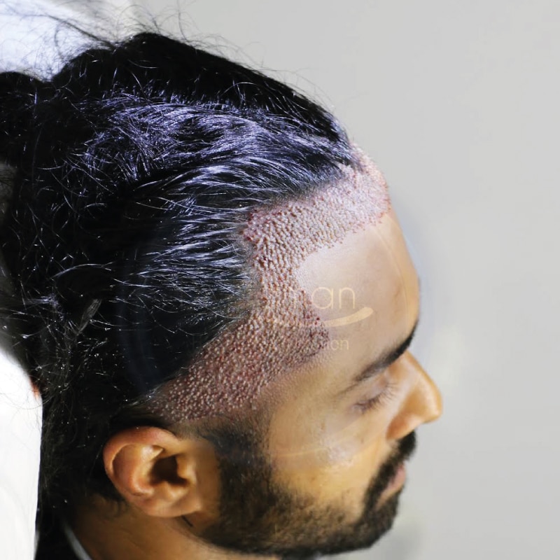 hair restoration process