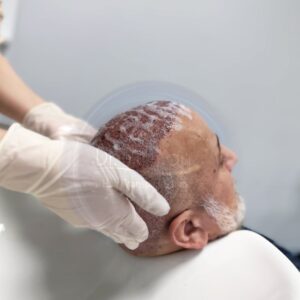 washing hair after hair transplant