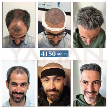 4150 Grafts Before - After