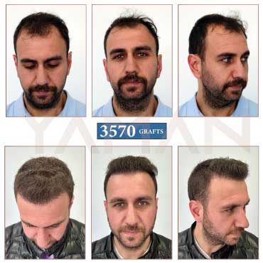 3570 Grafts Before - After