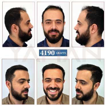 4190 Grafts Before - After