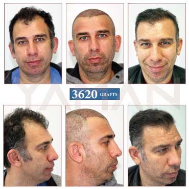 3620 Grafts Before - After