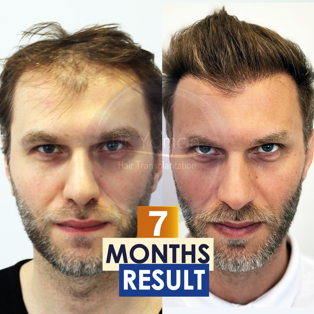 How Long Does it Usually Take to See Noticeable Results After a Hair Transplant