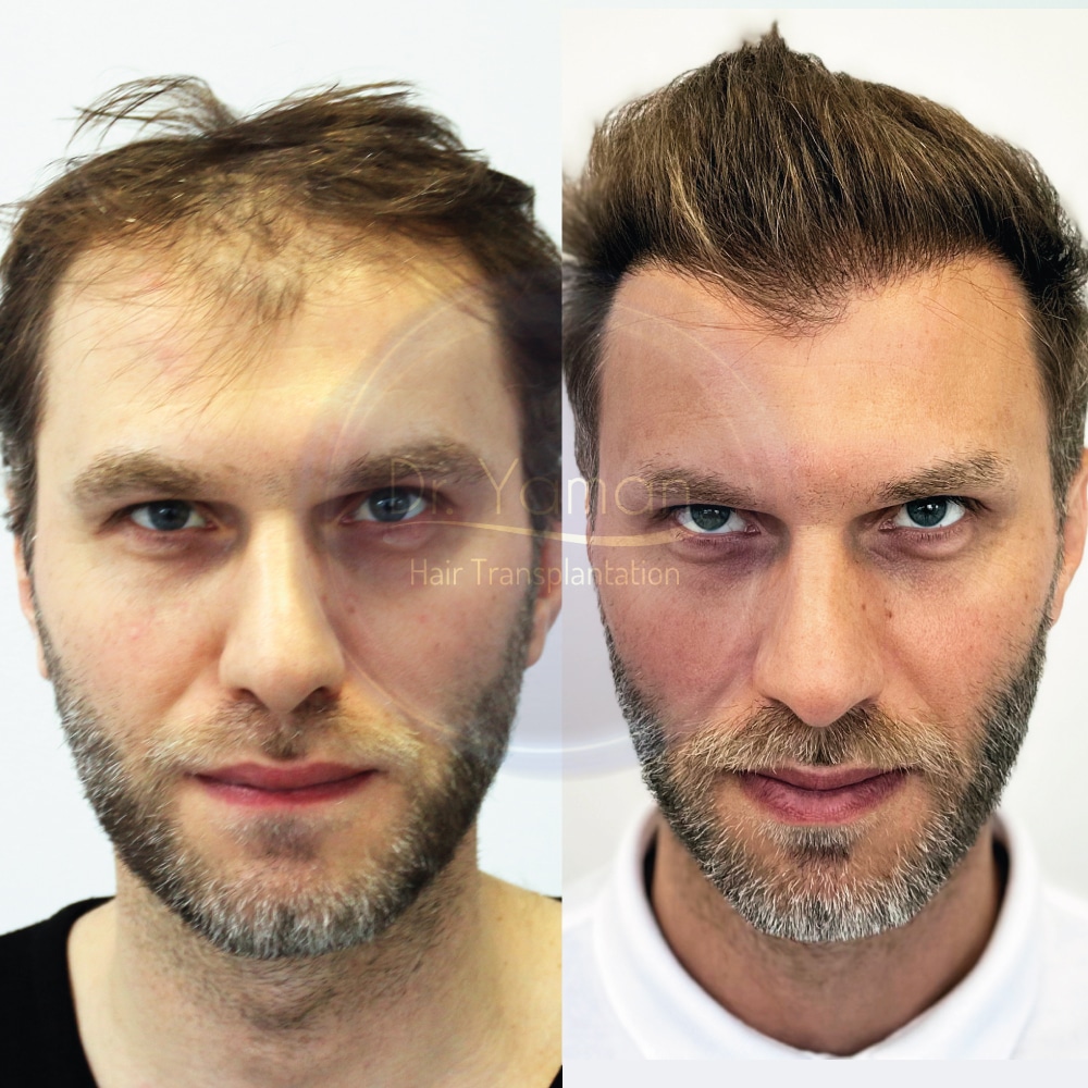 Natural Beauty Redefined: DHI Hair Restoration Stories You Need to Read