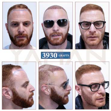 3930 Grafts Before - After