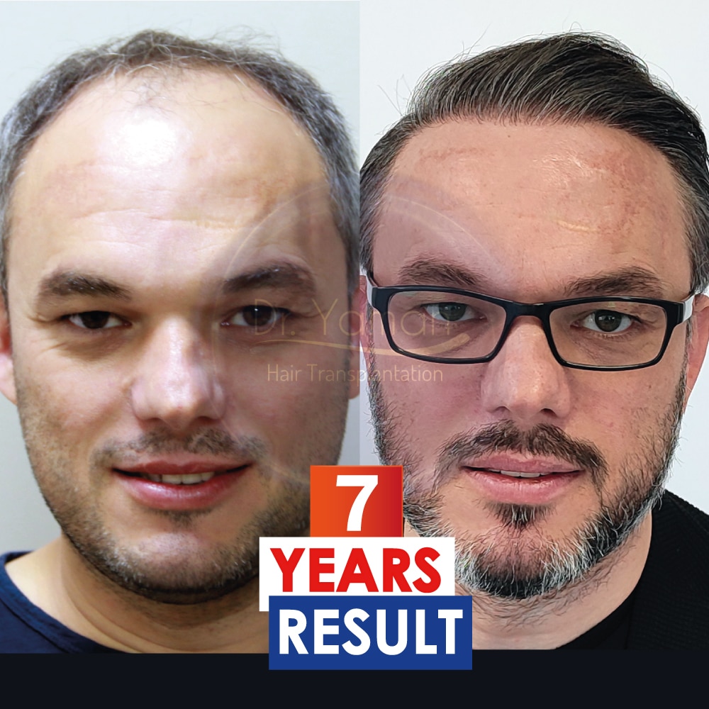 Are Hair Transplants Permanent