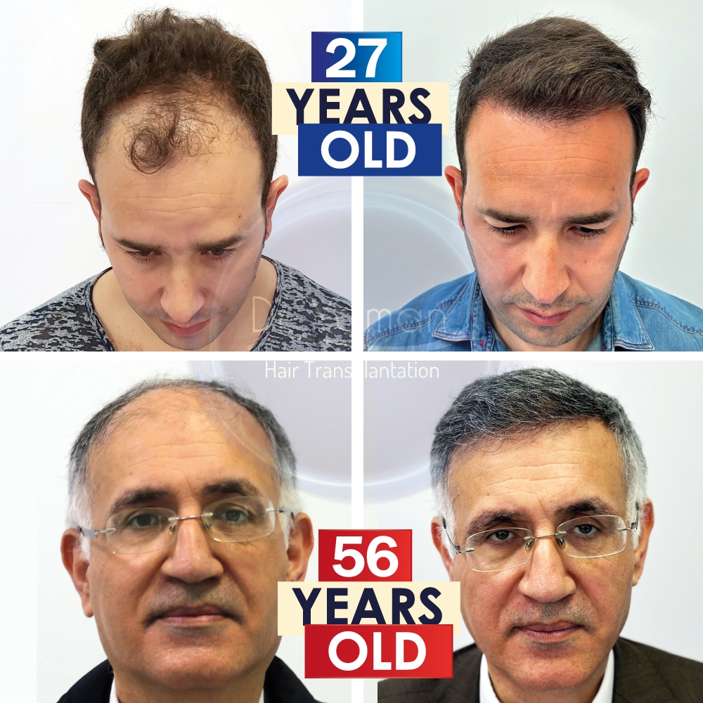 What is the Best Age for a Hair Transplant