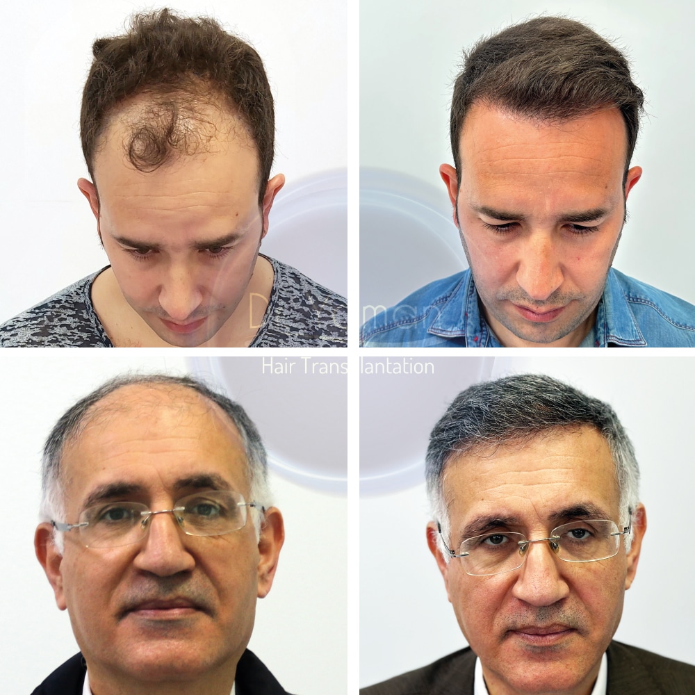 DHI Hair Transplant Results: Month by Month Progression