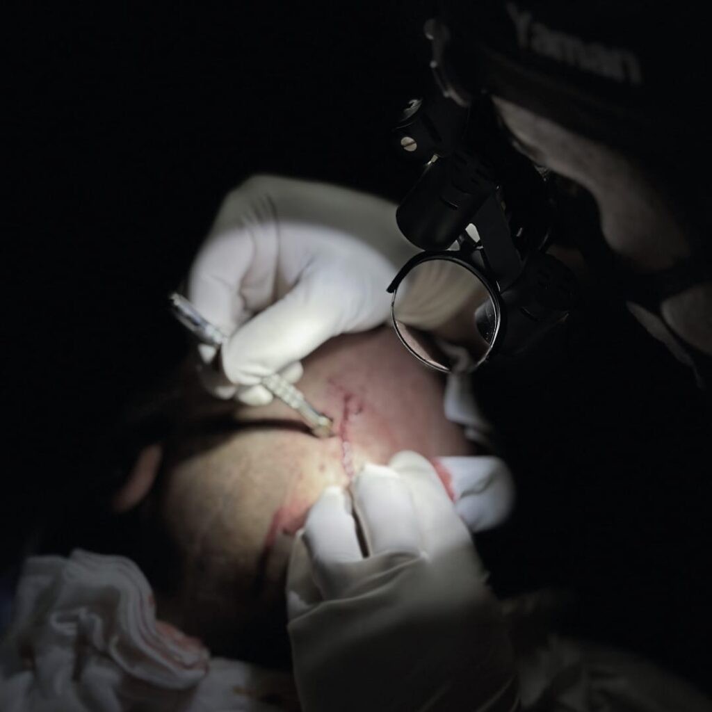 7 Factors to Consider When Choosing a Clinic for DHI Hair Transplant