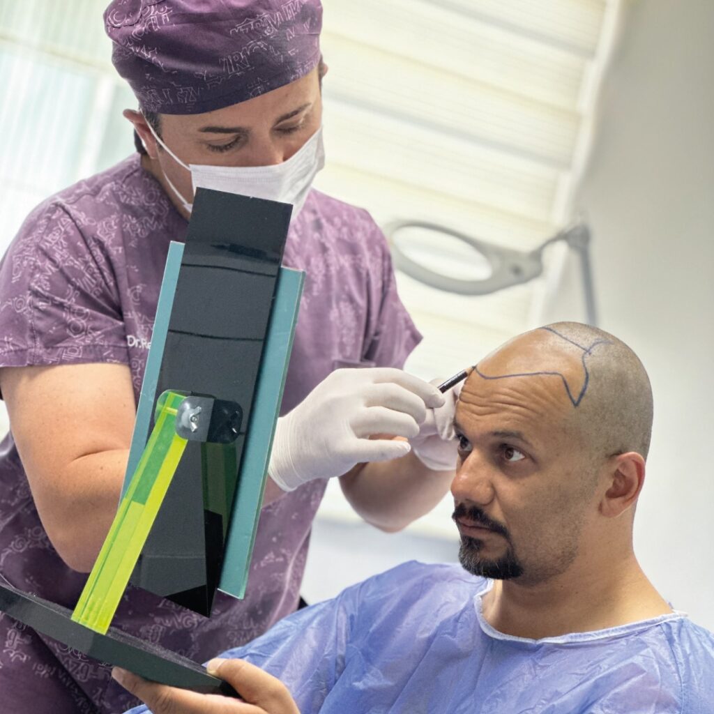 How Many Hair Grafts Do I Need For My FUE Hair Transplant