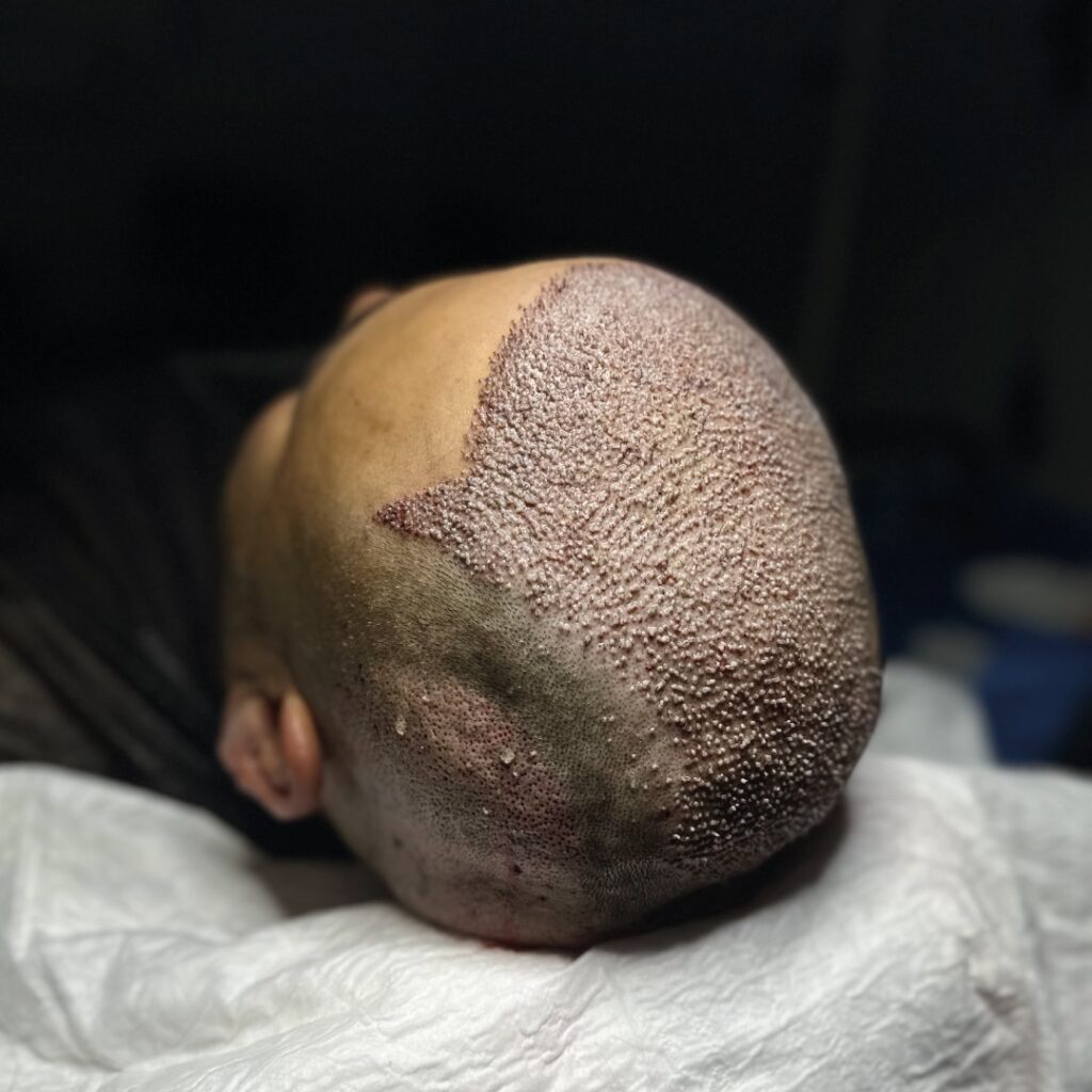 Are Hair Transplants Worth It