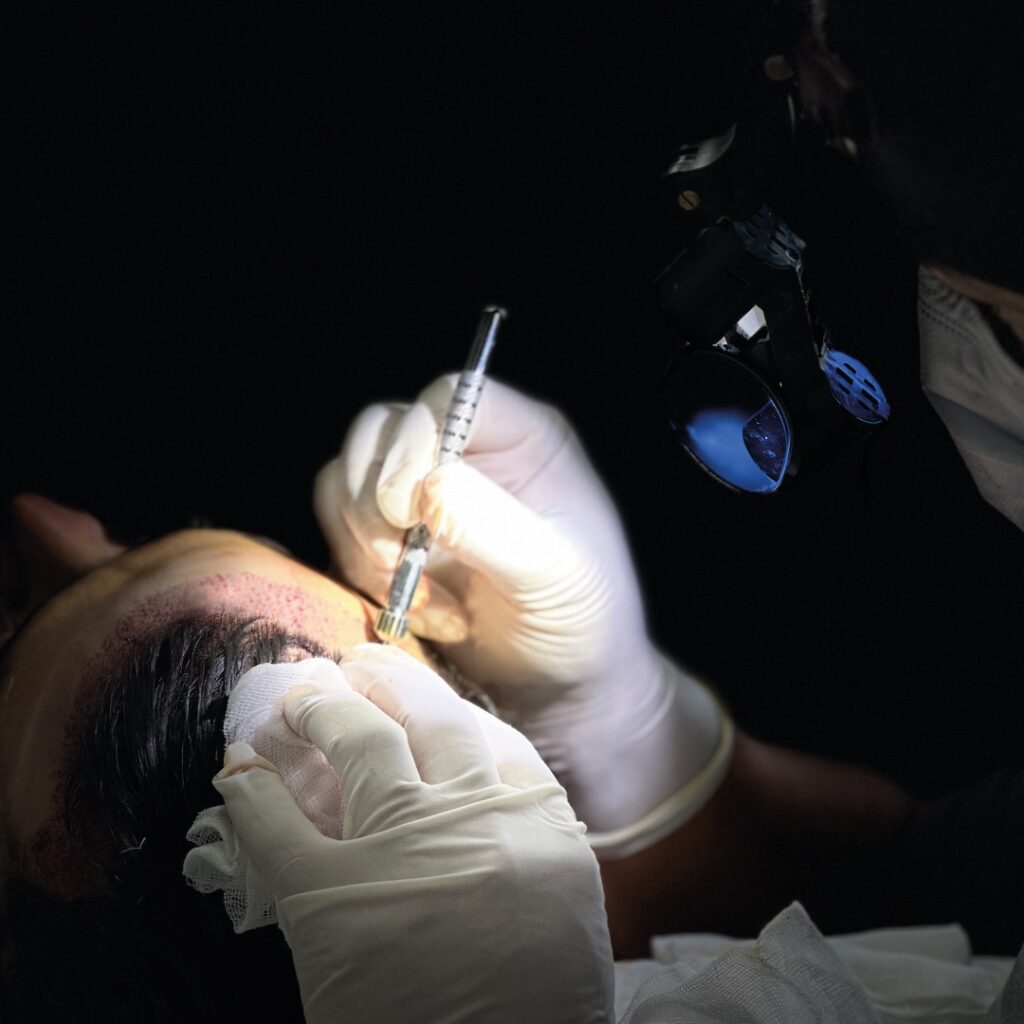 DHI vs FUE Hair Transplant: Pros and Cons of Each