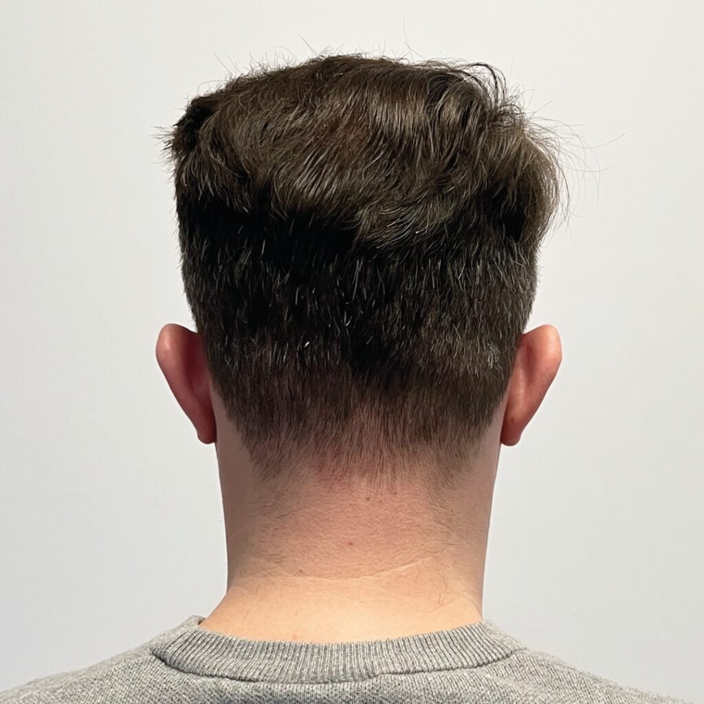 Does Donor Area Hair Grow Back