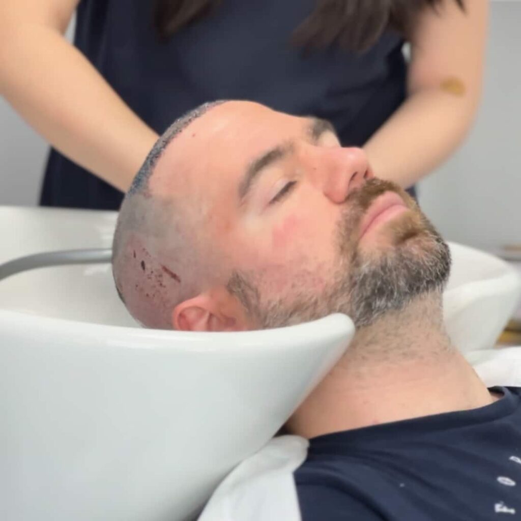 How Many Days After a Hair Transplant Can I Sleep Normally