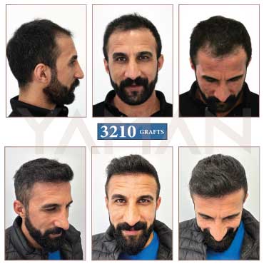 3210 Grafts Before – After