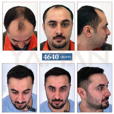 4650 grafts before and after