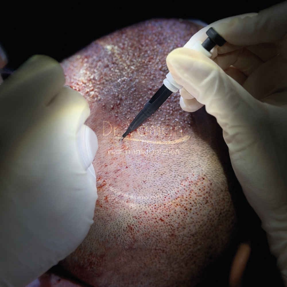 Results of DHI Hair Transplant