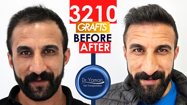 3000 Grafts DHI Hair Transplant