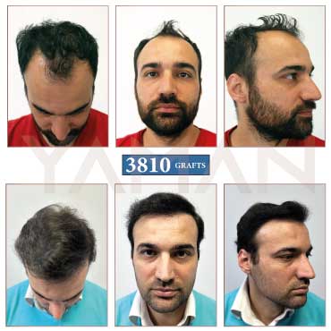 3810 Grafts Before – After