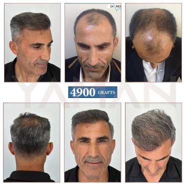 4900 Grafts 8 Years Hair Transplant Before After