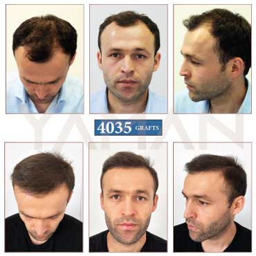 4035 Grafts Hair Transplant Before and After