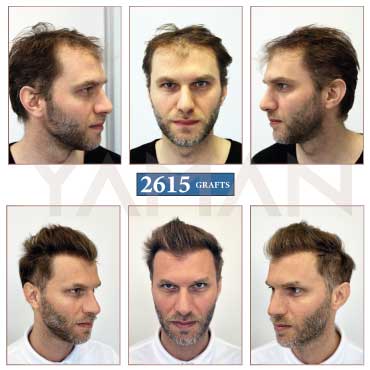 2615 Grafts Before and After